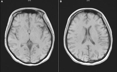 A Case Report of Leukocytosis During Modified Electroconvulsive Therapy of Paranoid Personality Disorder